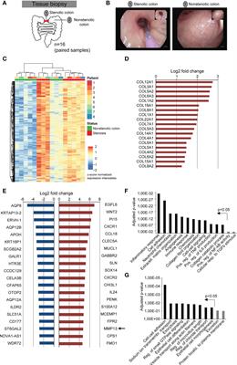 Interleukin 36 receptor-inducible matrix metalloproteinase 13 mediates intestinal fibrosis